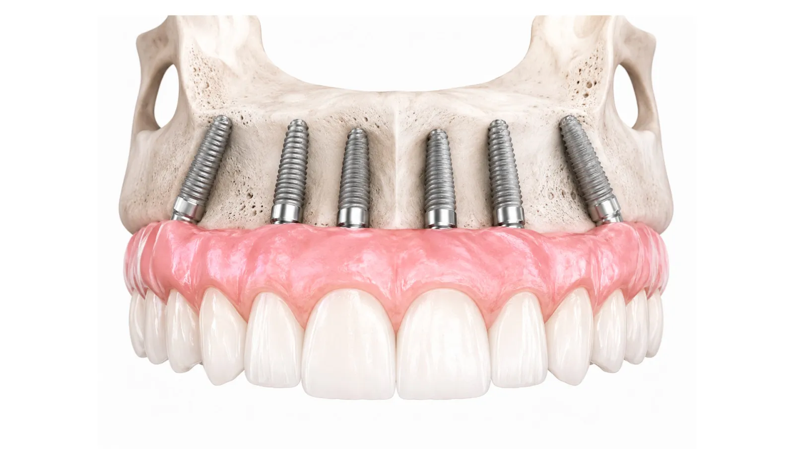 Prótesis All on Six: por qué 6 mejor que 4 implantes