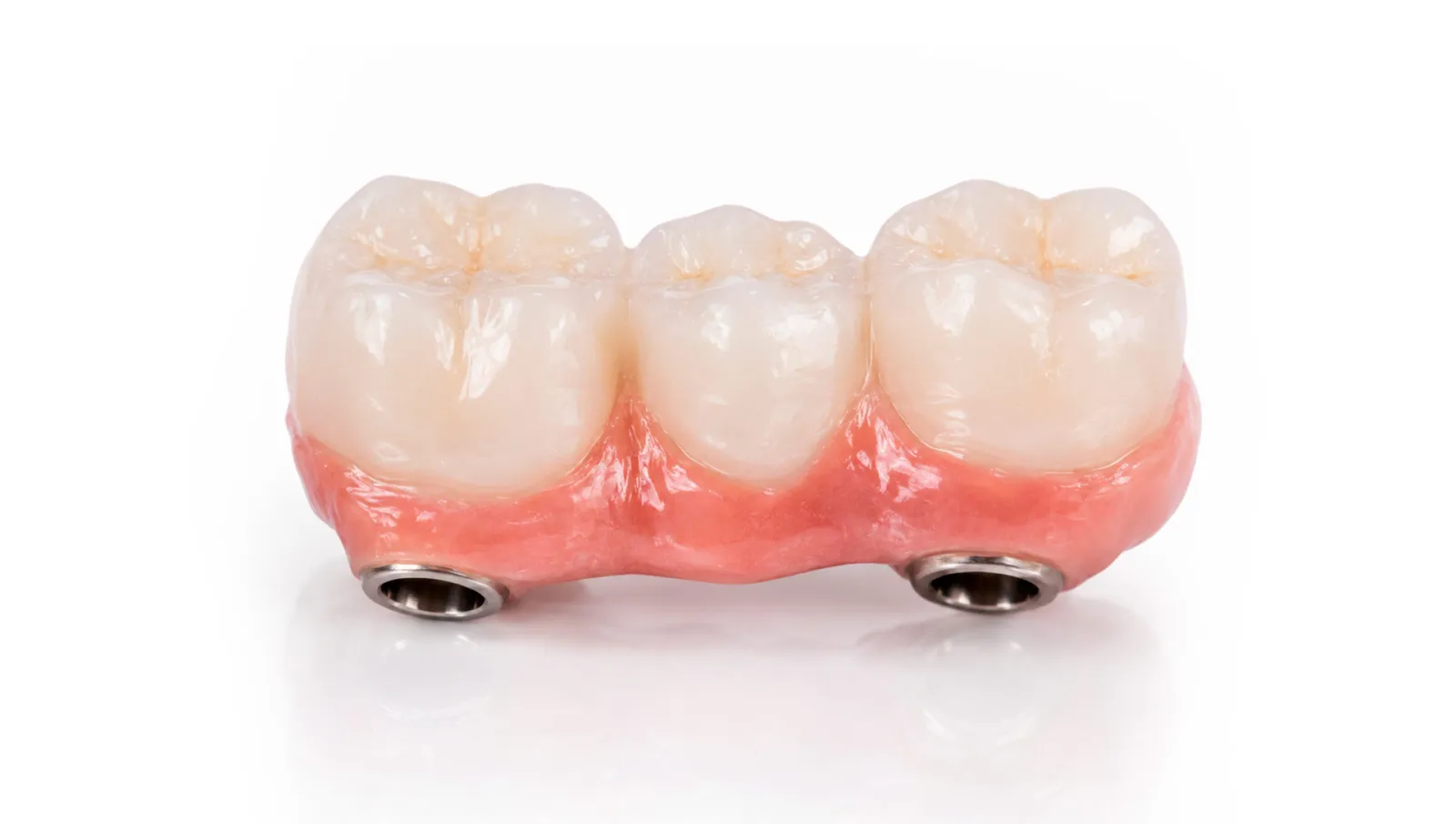 Puente dental: guía completa para recuperar dientes perdidos y volver a sonreír